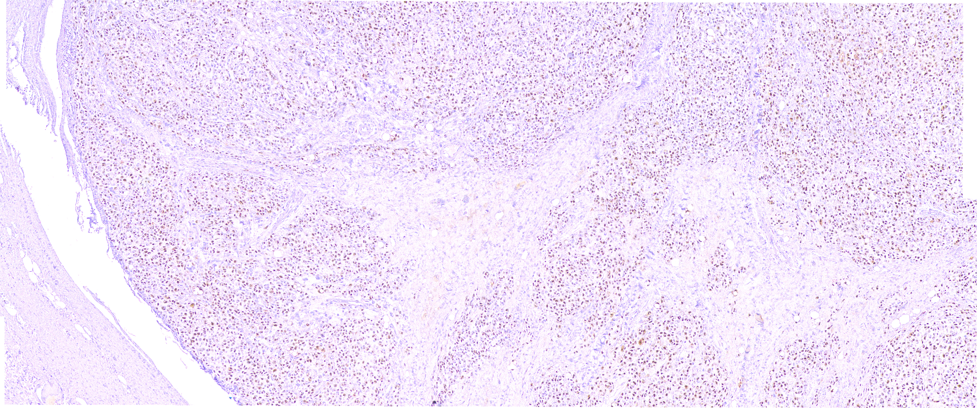 Lipoma Condroide